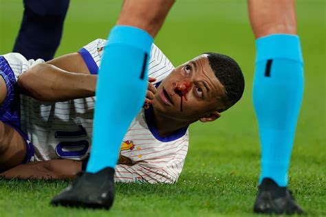 Le Français Kylian Mbappé évite une intervention chirurgicale suite à