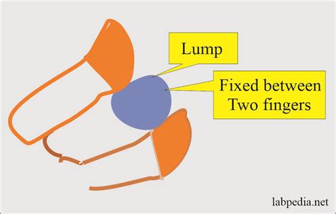 Fine Needle Aspiration Cytology (FNAC)