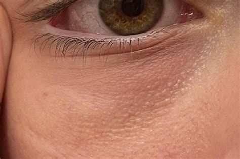 Are These Bumps Under My Eyes Milia I’ve Had Them As Long As I Can Remember [misc] R