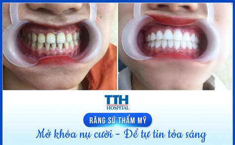 Tìm hiểu về công nghệ Hàm răng sứ đẹp Được sử dụng rộng rãi trong ngành