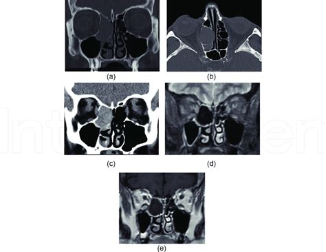 A Coronal Ct And B Axial Ct Demonstrate A Left Sided Hypoplastic