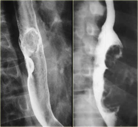 Esophageal Cancer Barium Swallow