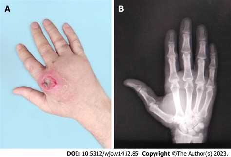 Septic Arthritis Finger