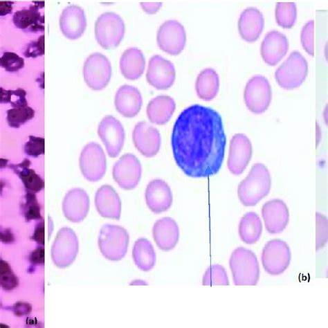 A Atypical Lymphocyte With Plasmacytoid Features Small Cell With Download Scientific Diagram