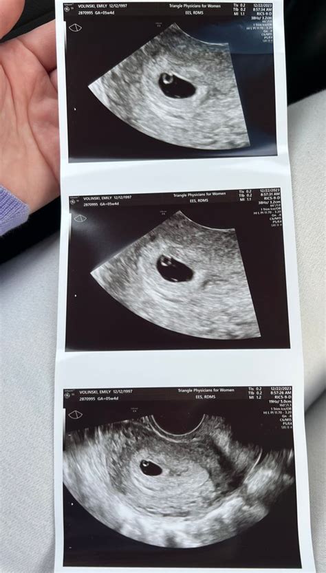 5w5d Ultrasound August 2024 Babies Forums What To Expect