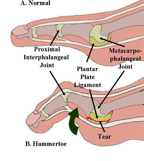 Austin Foot Specialists Discuss Plantar Plate Tear Austin Foot And