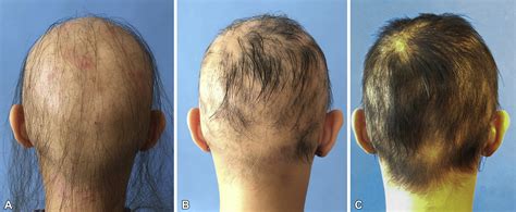 Tofacitinib 2 Ointment A Topical Janus Kinase Inhibitor For The Treatment Of Alopecia Areata