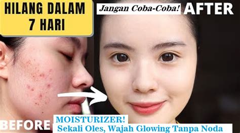 Moisturizer Untuk Kulit Berminyak Dan Berjerawat Mengandung Spf 15