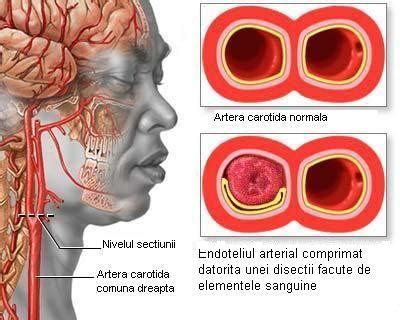 Accidentul Vascular Cerebral Cauze Simptome Preventie Si Tratare