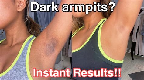 How To Get Rid Of Dark Armpits Instantly Works Dark Armpits