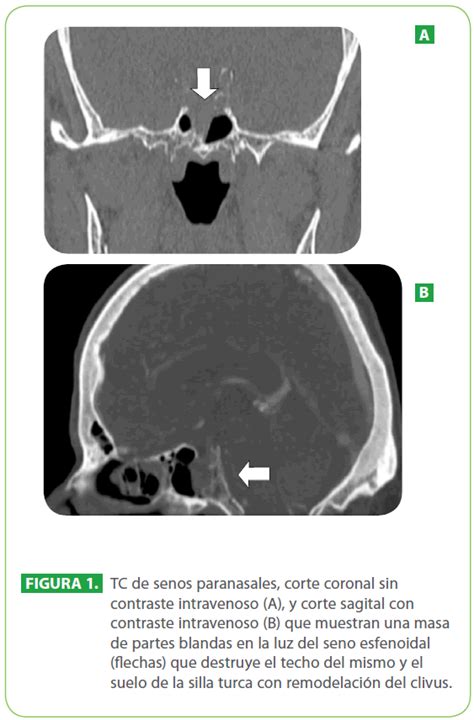 Tumor Carcinoide Del Seno Esfenoidal Una LocalizaciÃ Æ Ã