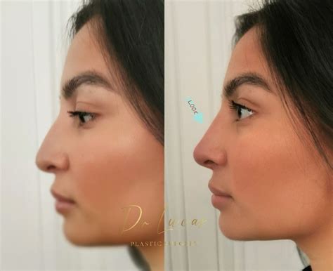 Rhinoplastie Médicale Par Acide Hyaluronique Ou Fils Tenseurs