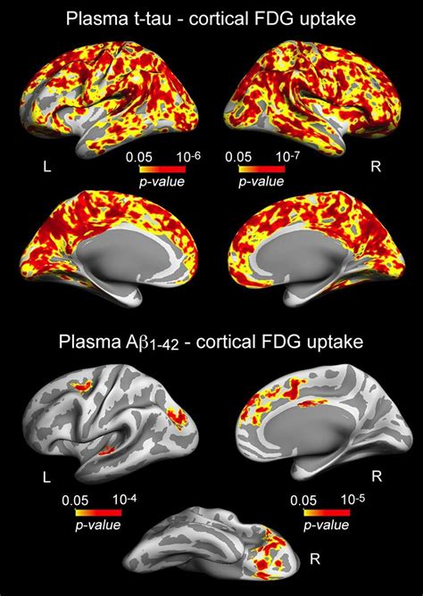 Significant Associations Between Increased Plasma T Tauaβ 1 42 And