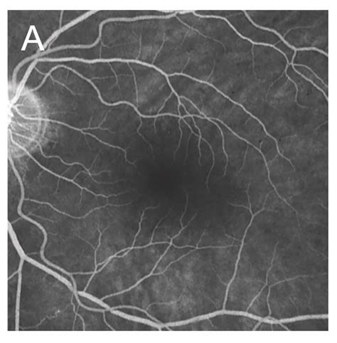 OCT-A in macular disorders: tips, tricks and practical clinical use ...