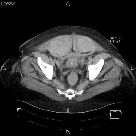 Spontaneous Rectus Sheath Hematomas Radiology Case Radiopaedia Org