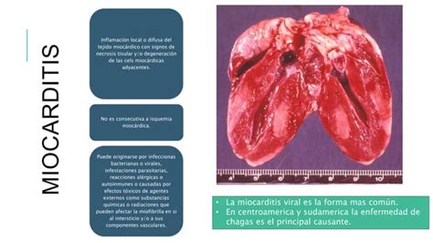 Miocarditis Ppt