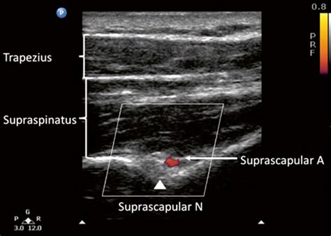 Ultrasound Pain Block Tip Of The Week Suprascapular Nerve Block