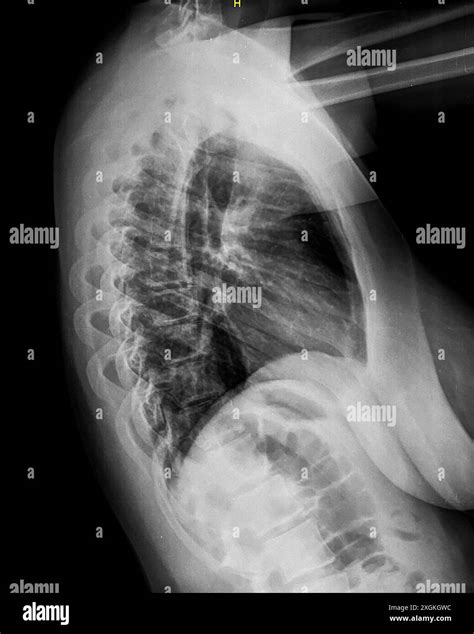 X Ray Of Thoracic Spine Lateral View Vertebrae And Intervertebral