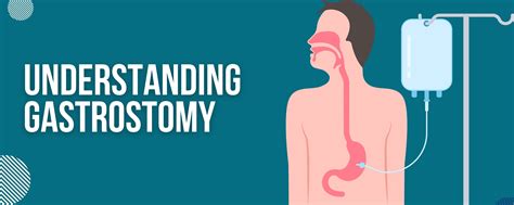 Understanding Gastrostomy Definition And Purpose — Medical Supply Pros