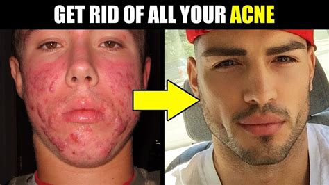 How To Instantly Eliminate Acne Fast How To Get Rid Of Acne And Pimples Youtube