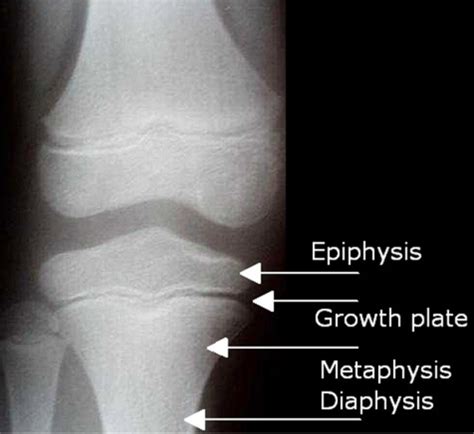 Msk Rheum Radiology High Yield Pance Flashcards Quizlet