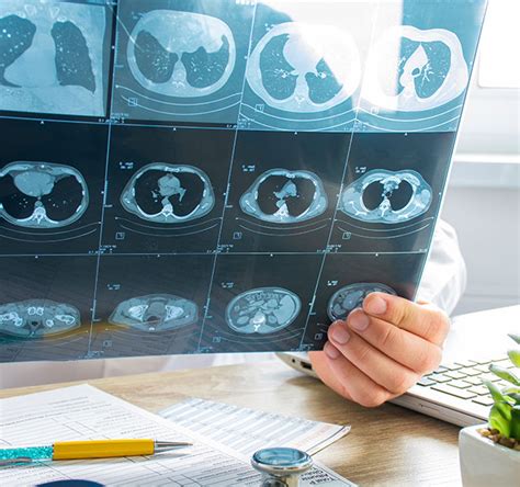 Screening Can Detect Lung Cancer Early Heres Who Should Be Screened