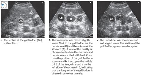 Gallbladder Radiology Key