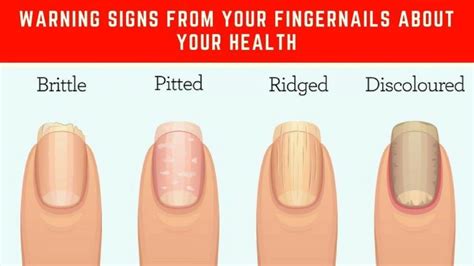 8 Important Signs Your Fingernails Can Tell About Your Health Nail