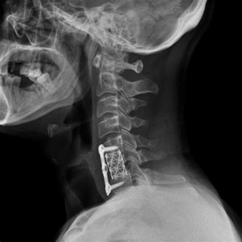 Cervical Spine Mri Shows An Epidural Abscess At The C5‐c6 Levels