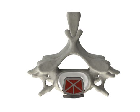 Cervical Spine Truss System Integrated Plate Web Medical