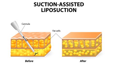 Know The Potential Risks Of Liposuction Medlinks Look Good