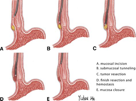 Figure 1 From Submucosal Tunneling Endoscopic Resection A New