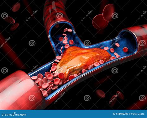 3d Illustration Of Deep Vein Thrombosis Or Blood Clots Embolism Stock