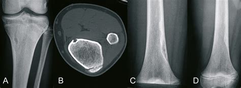 Orthoforum Nicht Ossifizierendes Fibrom Nof