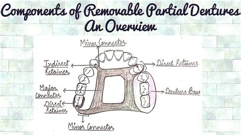 Components Of Removable Partial Denture