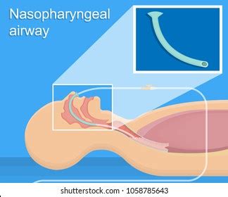 Nasopharyngeal Airway Images, Stock Photos & Vectors | Shutterstock