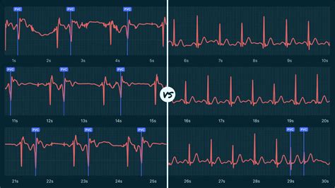 Ventricular Bigeminy Vs Premature Ventricular Contraction Couplet On