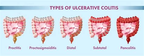 Ulcerative Colitis Treatment In Pune Kaizen Gastro Care