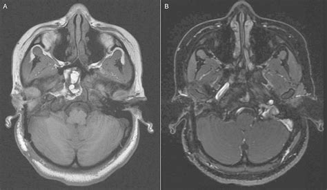 A Axial T1 Weighted Magnetic Resonance Mr Image Shows Hyperintense