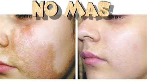 Como Eliminar Paño Hiperpigmentación Melasma Manchas En La Cara El