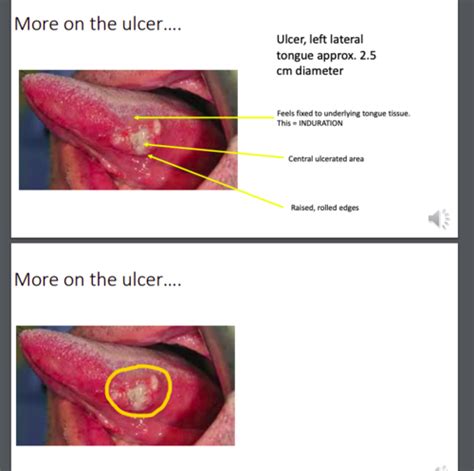 Oral Cancer Patient Journey Flashcards Quizlet