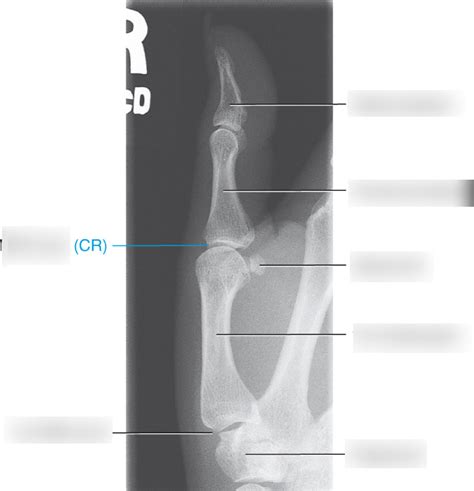 DIAGRAM - Lateral Thumb Anatomy(Xray) - 2018 Diagram | Quizlet