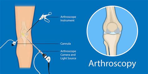 Osteochondral Injuries - Oxford Orthopaedics Clinic