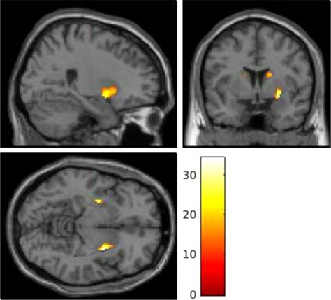 The Neural And Molecular Basis Of Working Memory Function In Psychosis