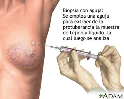 Biopsia con aguja del seno MedlinePlus enciclopedia médica illustración