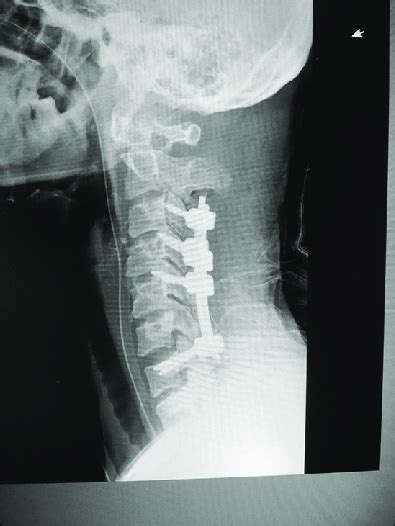 Lateral Image Showing Cervical Pedicle Screws Using Lateral Vertebral Download Scientific