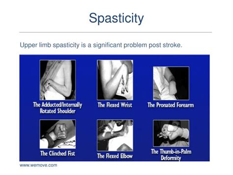 Upper Extremity Spasticity