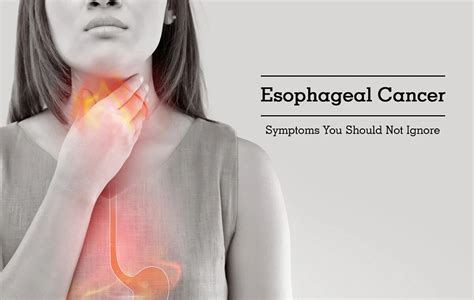 Esophageal Cancer Symptoms By University Cancer Centers On Dribbble