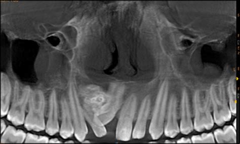 Preoperative Opg Reveals A Well Defined Radiopaque Mass With A