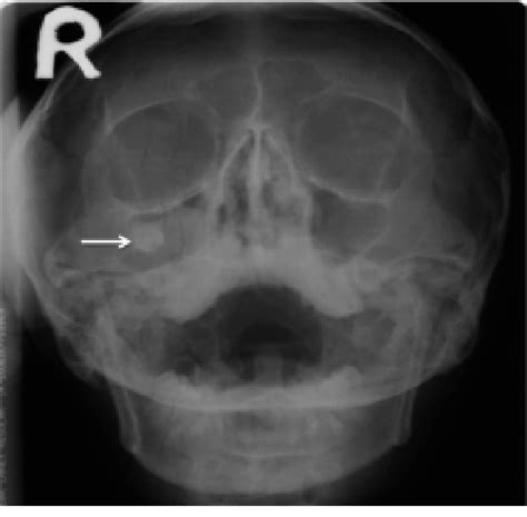 Figure 1 From Keratocystic Odontogenic Tumor Invading The Right